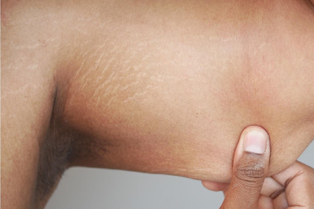 Stretch Marks Treatment Near Me